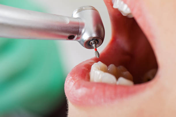 Best Emergency Dental Extractions in Silver Lake, FL